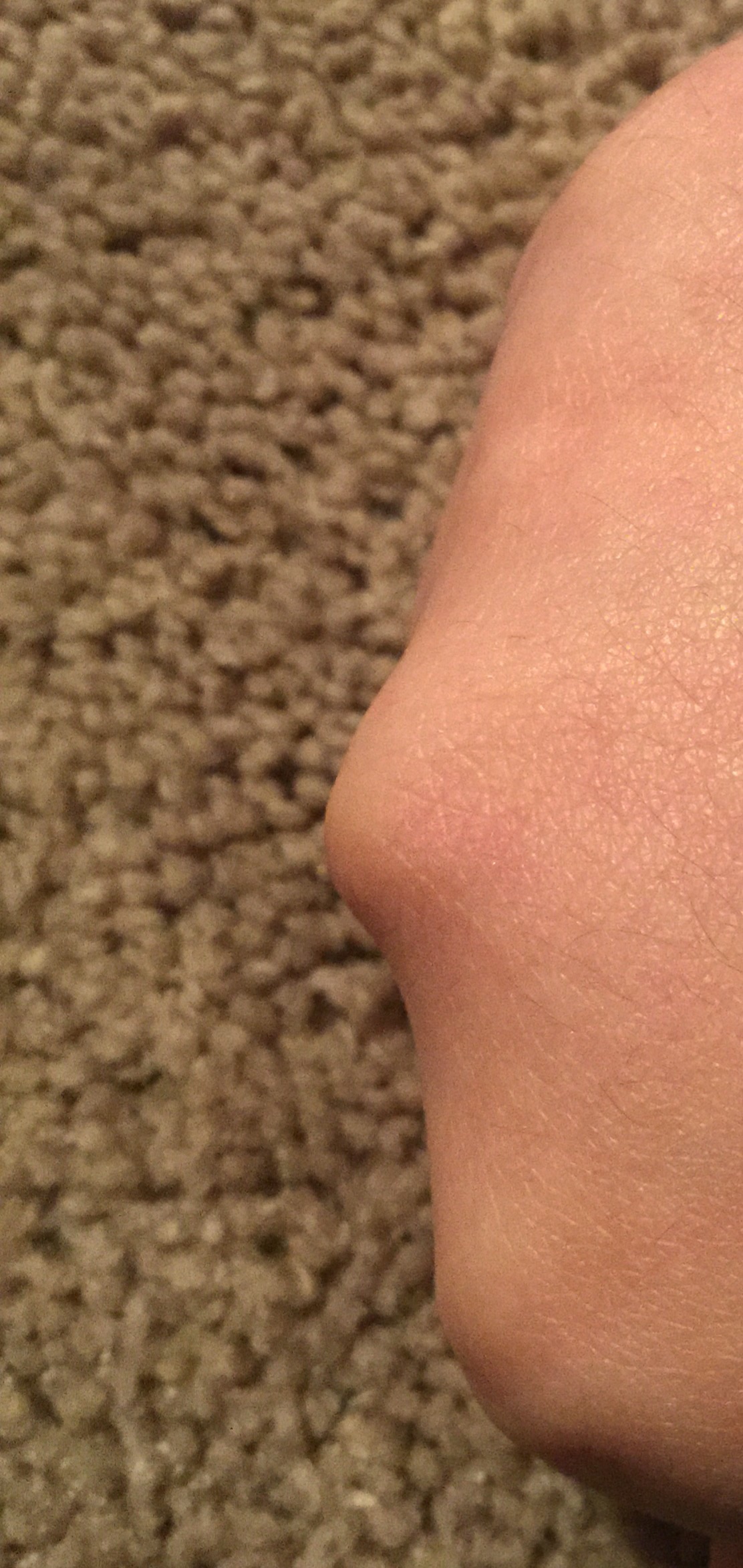 Cracking knuckles result