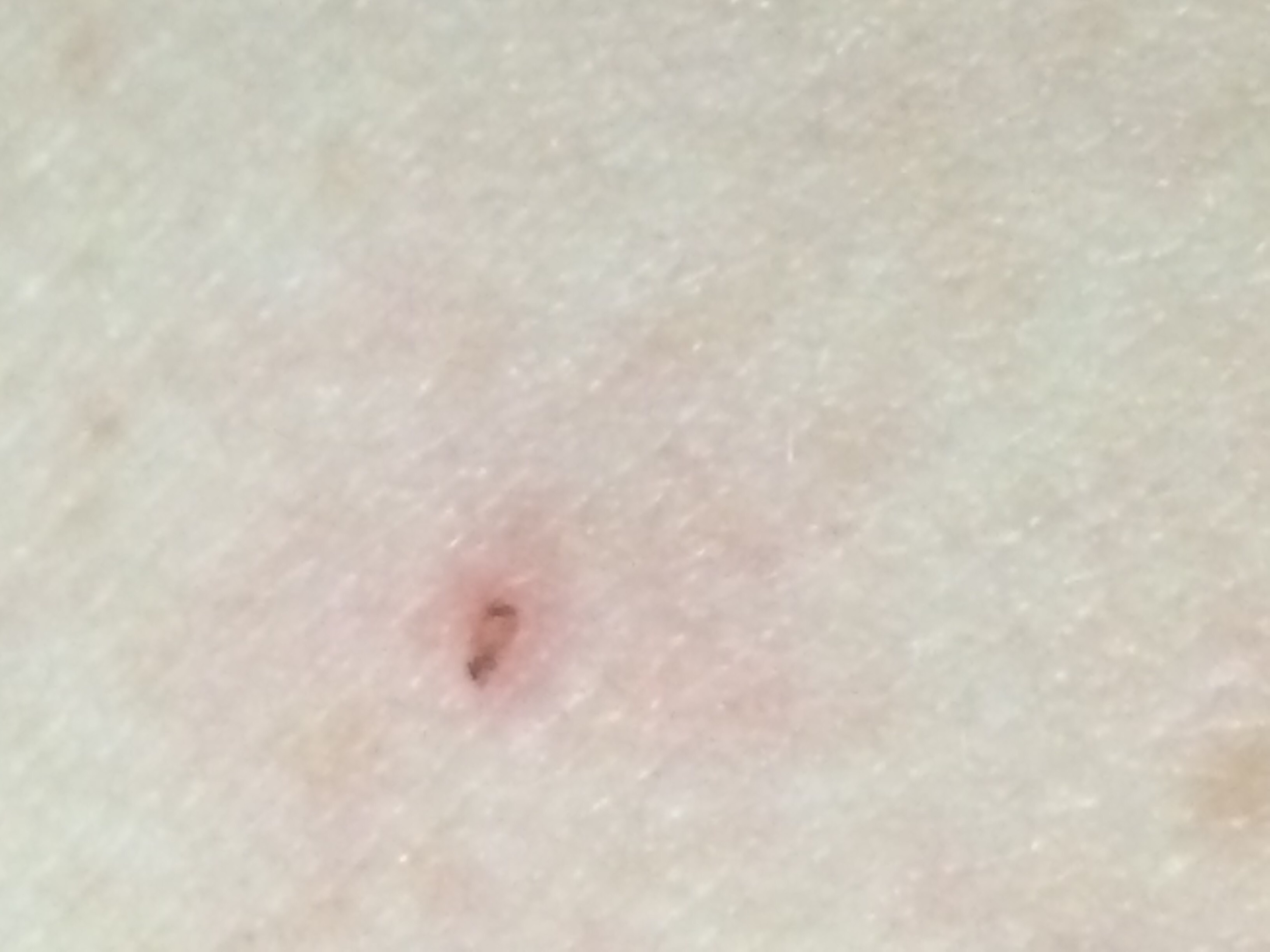 Suspicious Freckle on Back