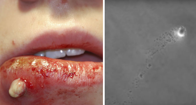 MRSA.jpg