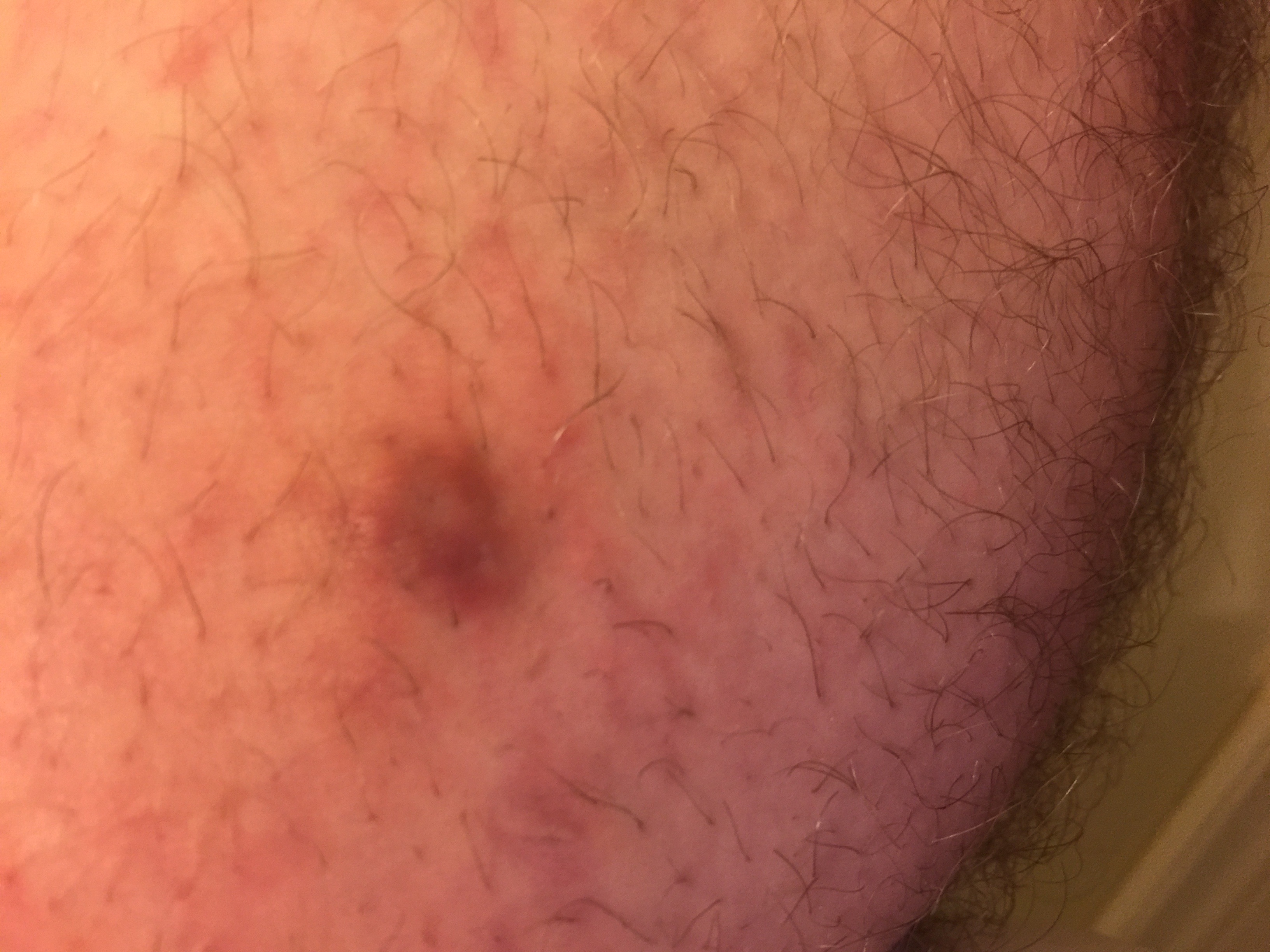 Really don't think it's a pimple