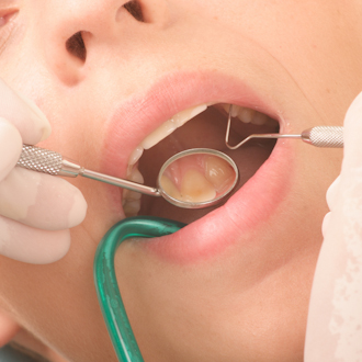 Dental Laminates India