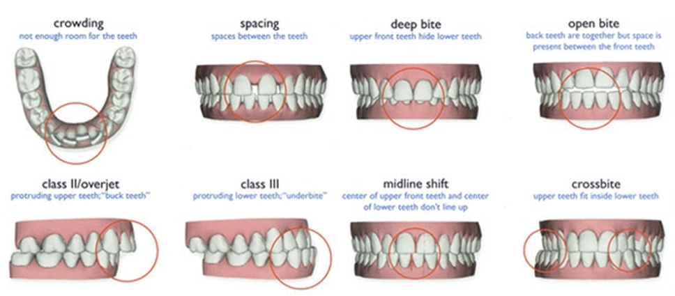 TypesofMalocclusions.png