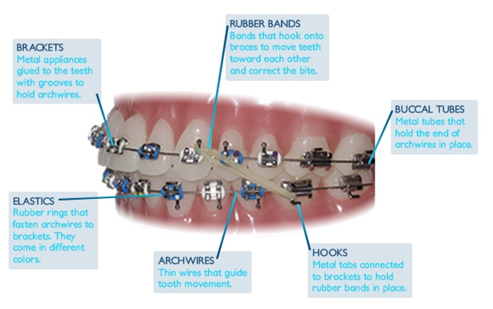 TraditionalMetalbraces.png