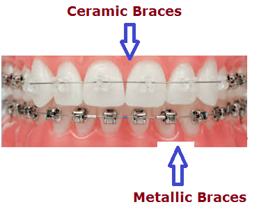 Ceramicandmetalbraces.png