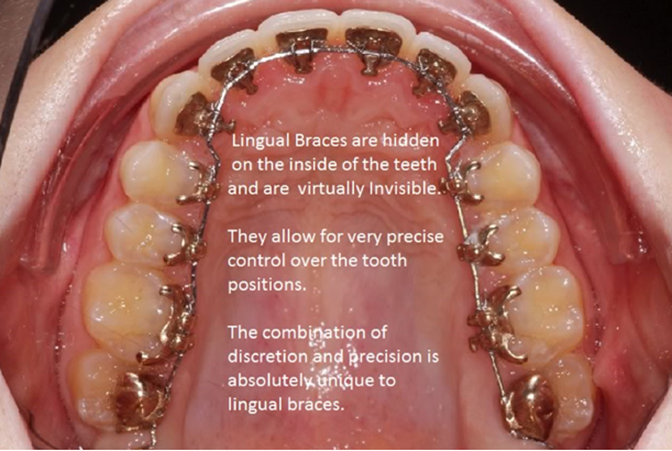 Lingualbraces.png