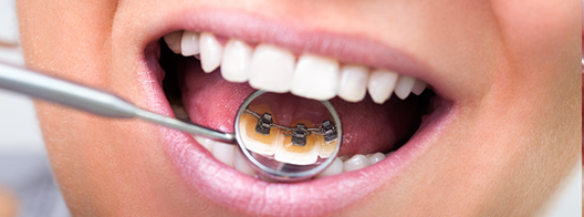 Lingualbraces2.png