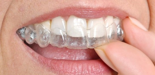 Clearaligners.png