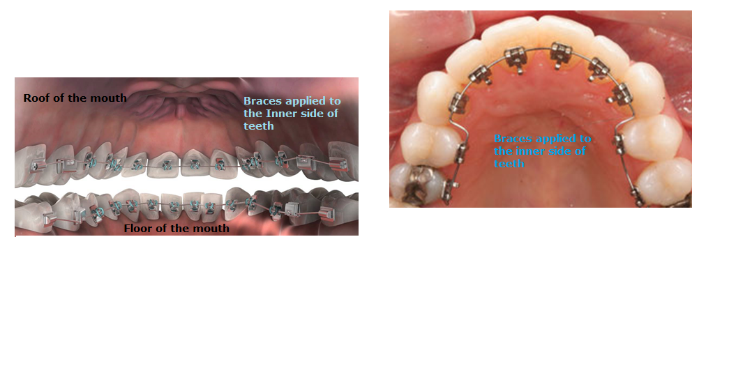 Lingualbraces3.png