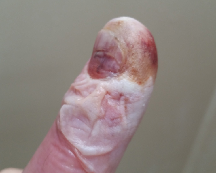 Day Two - Preop