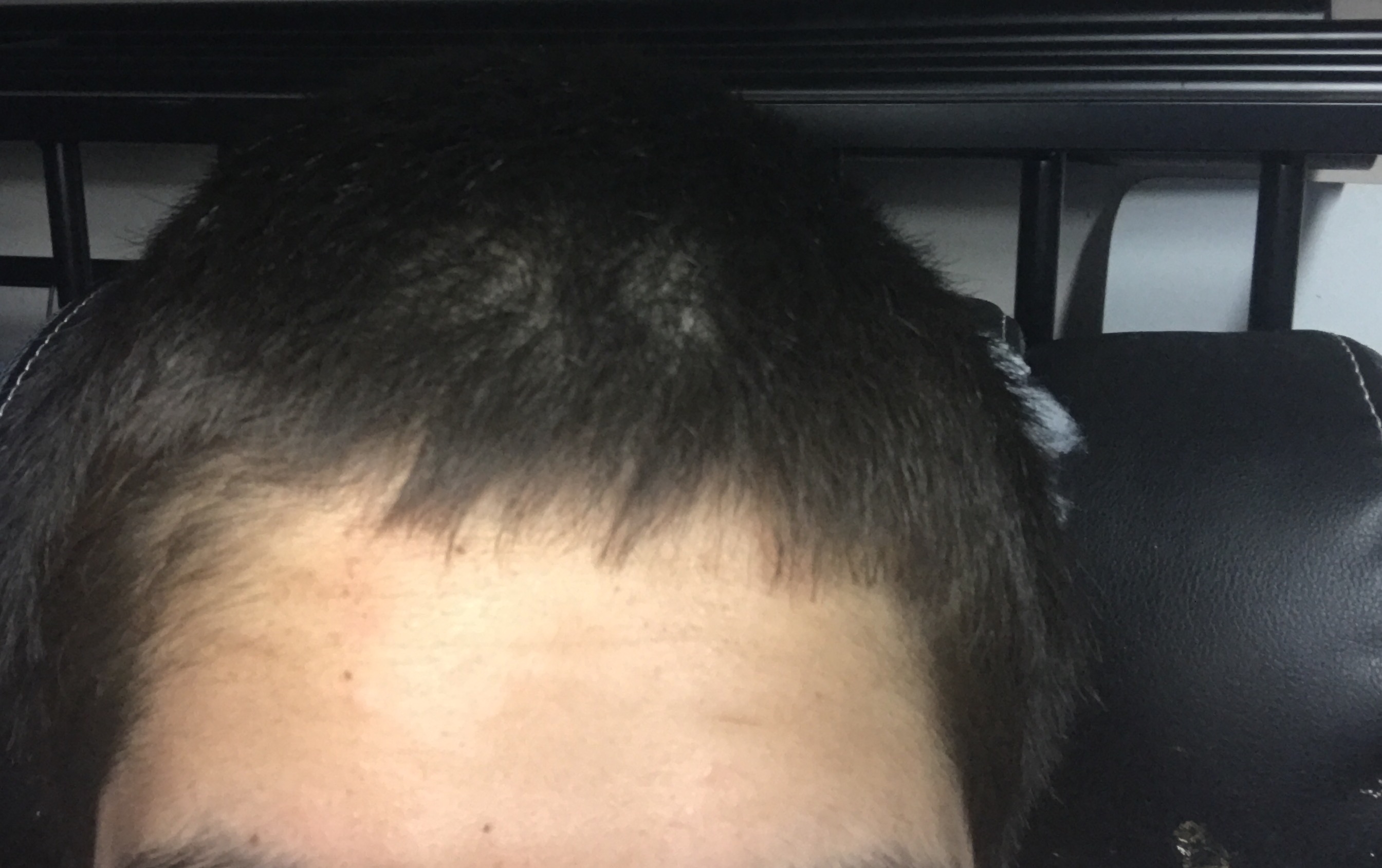 Bad hairline