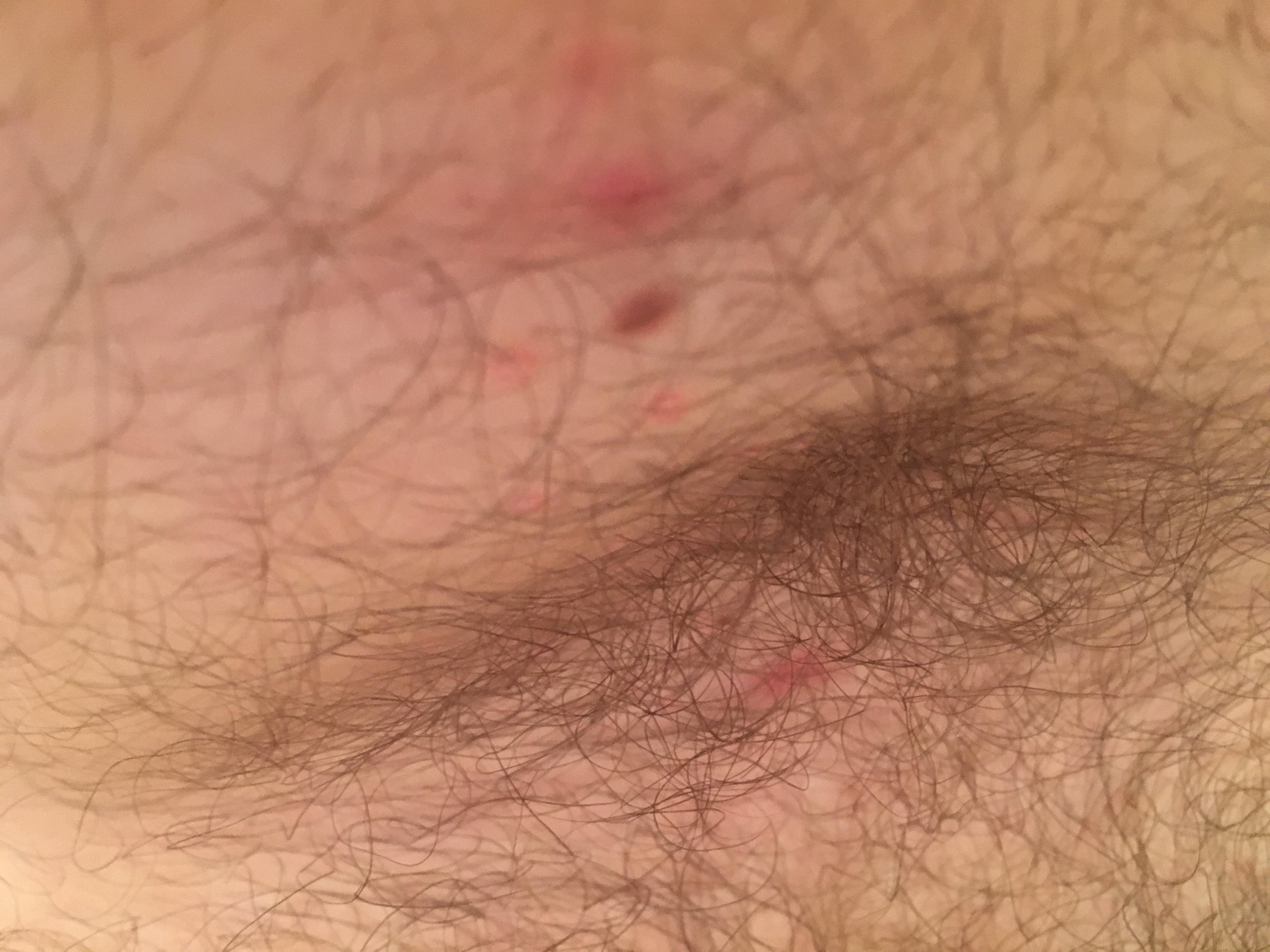 Rash