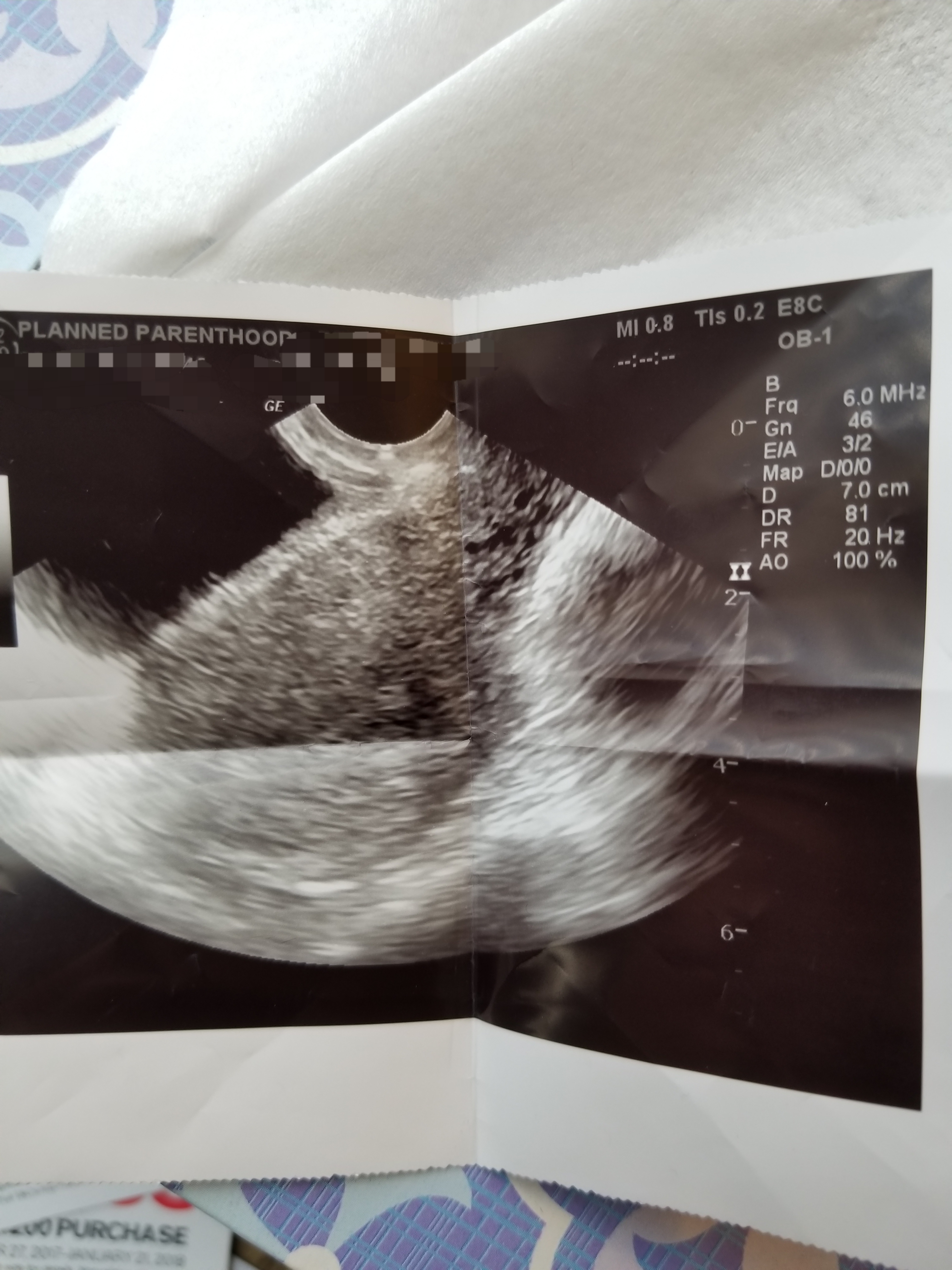 Ultrasound