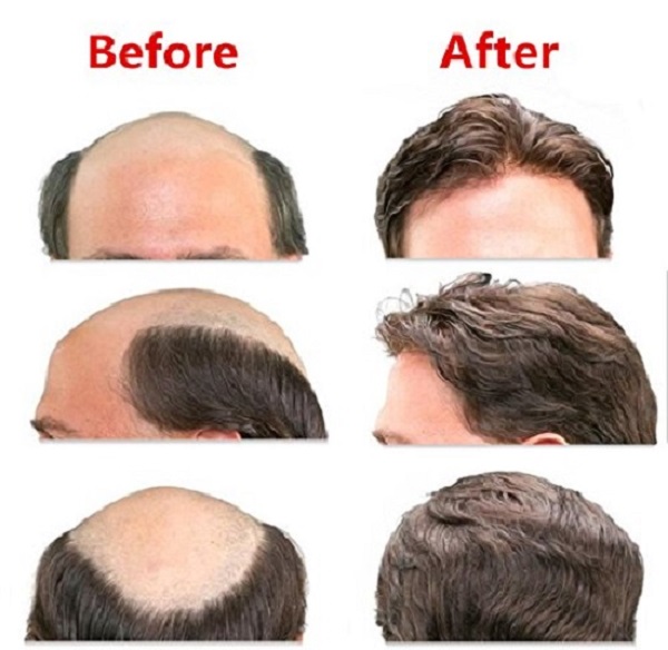 Looking Mens Hair Systems in US at Attainable Price