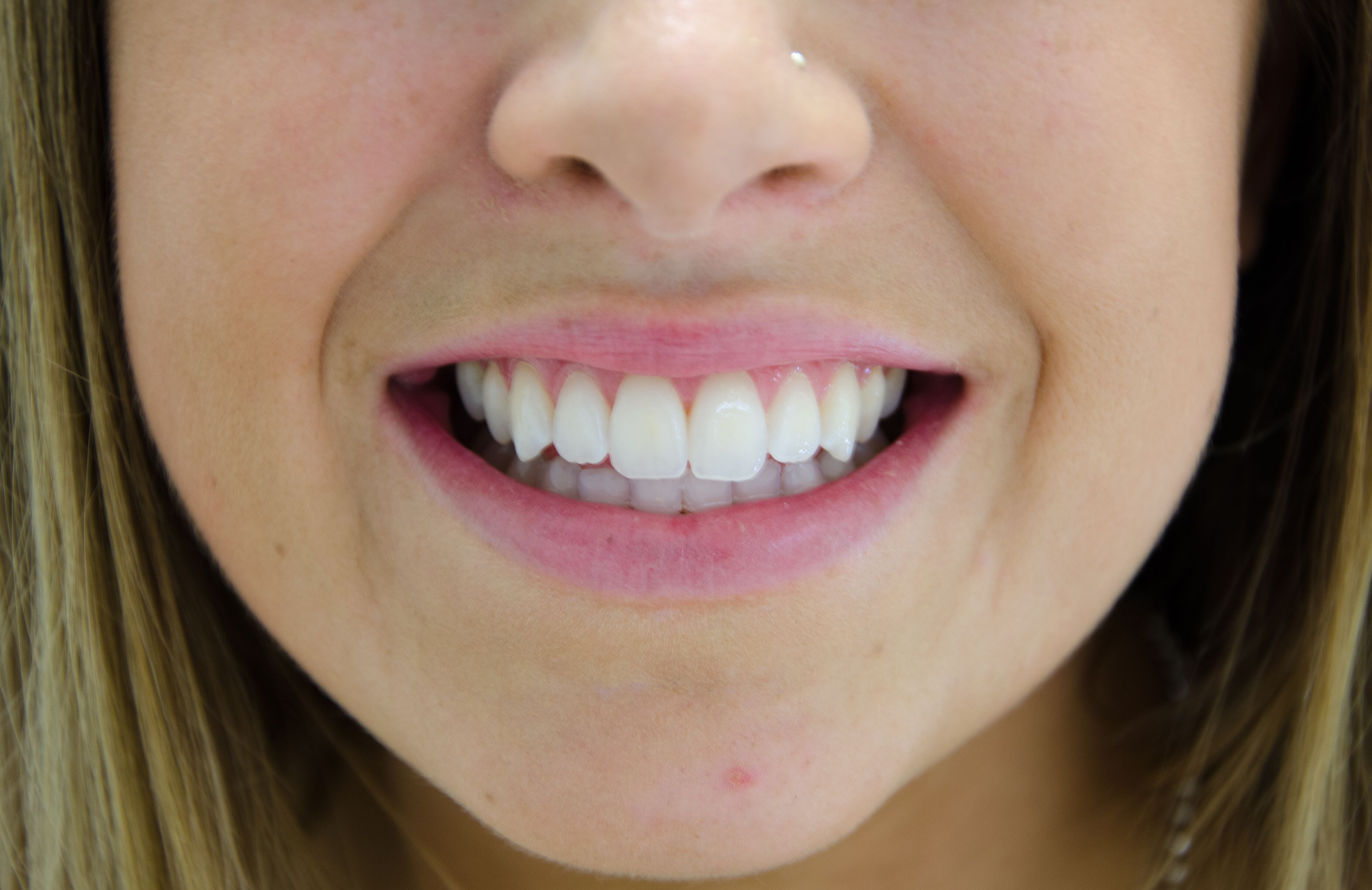We Offer the Advanced Teeth Whitening Treatment at an Affordable Price