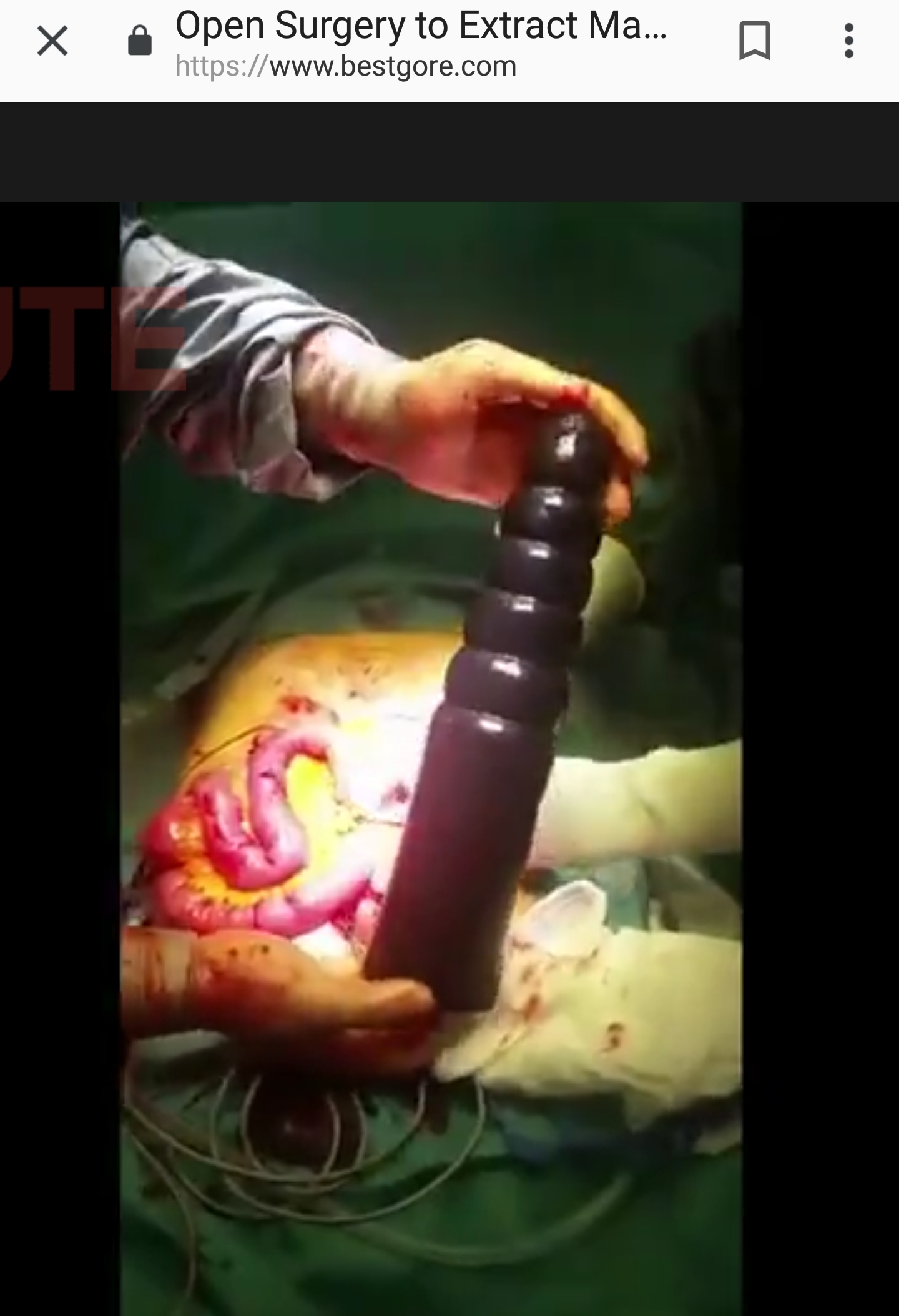 Dildo surgery