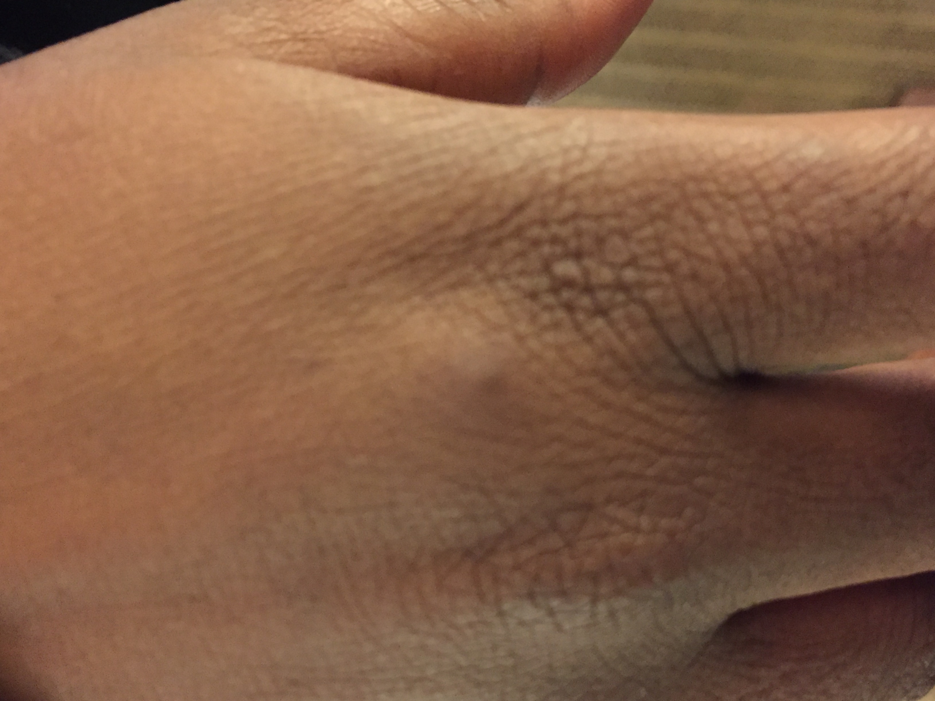 BedBug Bite 1
