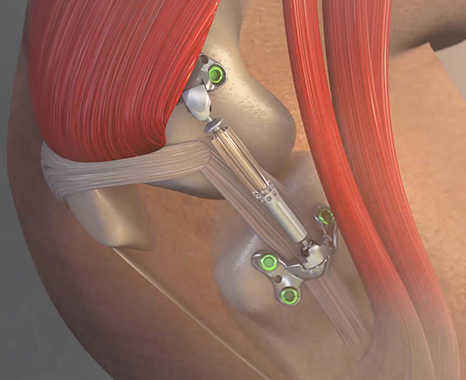 bone-implant-side.jpg