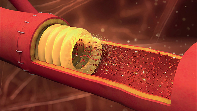 stent-in-vessel.jpg