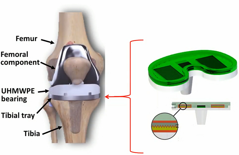 knee-implant.jpg