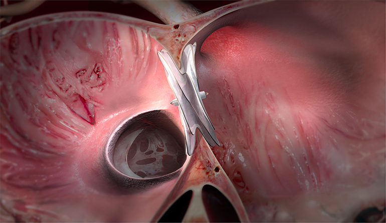 Septal-Occluder.jpg