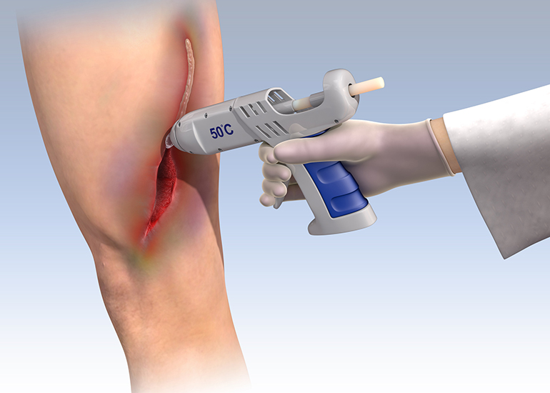 tissue-glue-gun.jpg