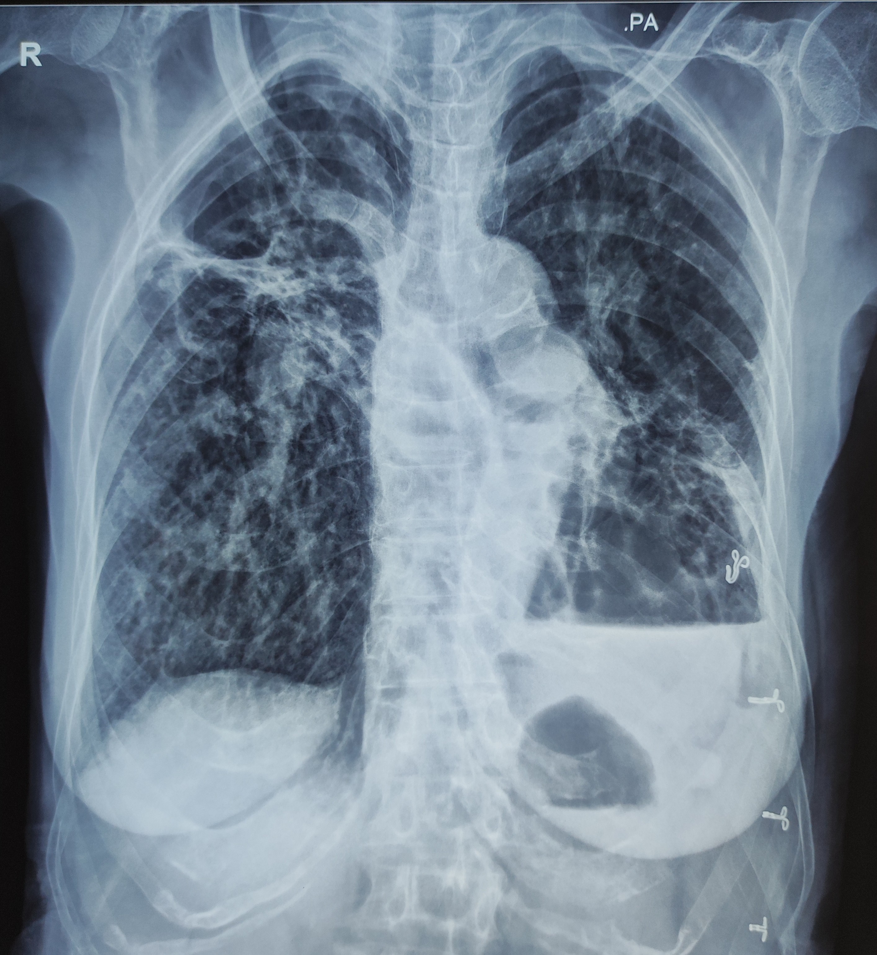 CXR