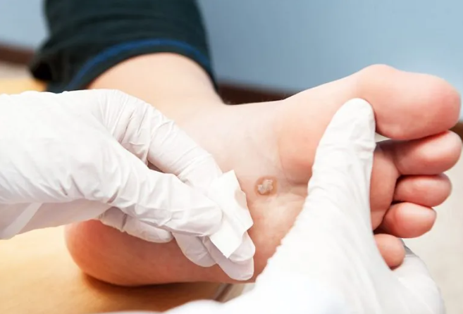 Best Warts Treatment in Kochi.png